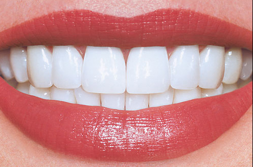 Everything You Need to Know About Zirconium Crowns