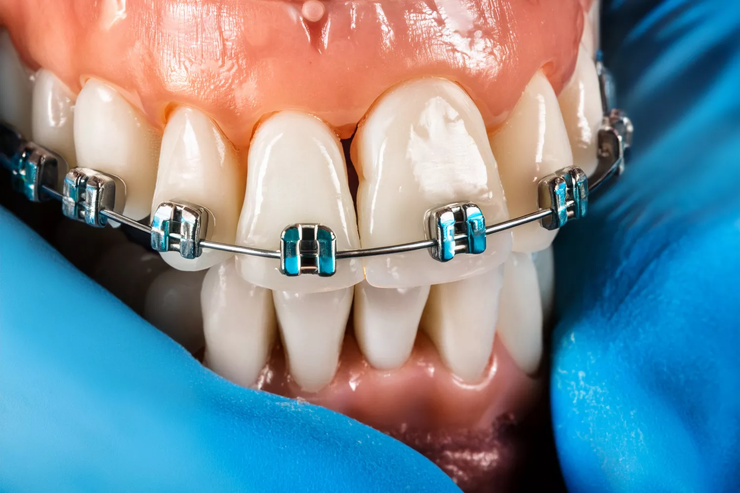 Missing Teeth and Orthodontic Braces Treatment