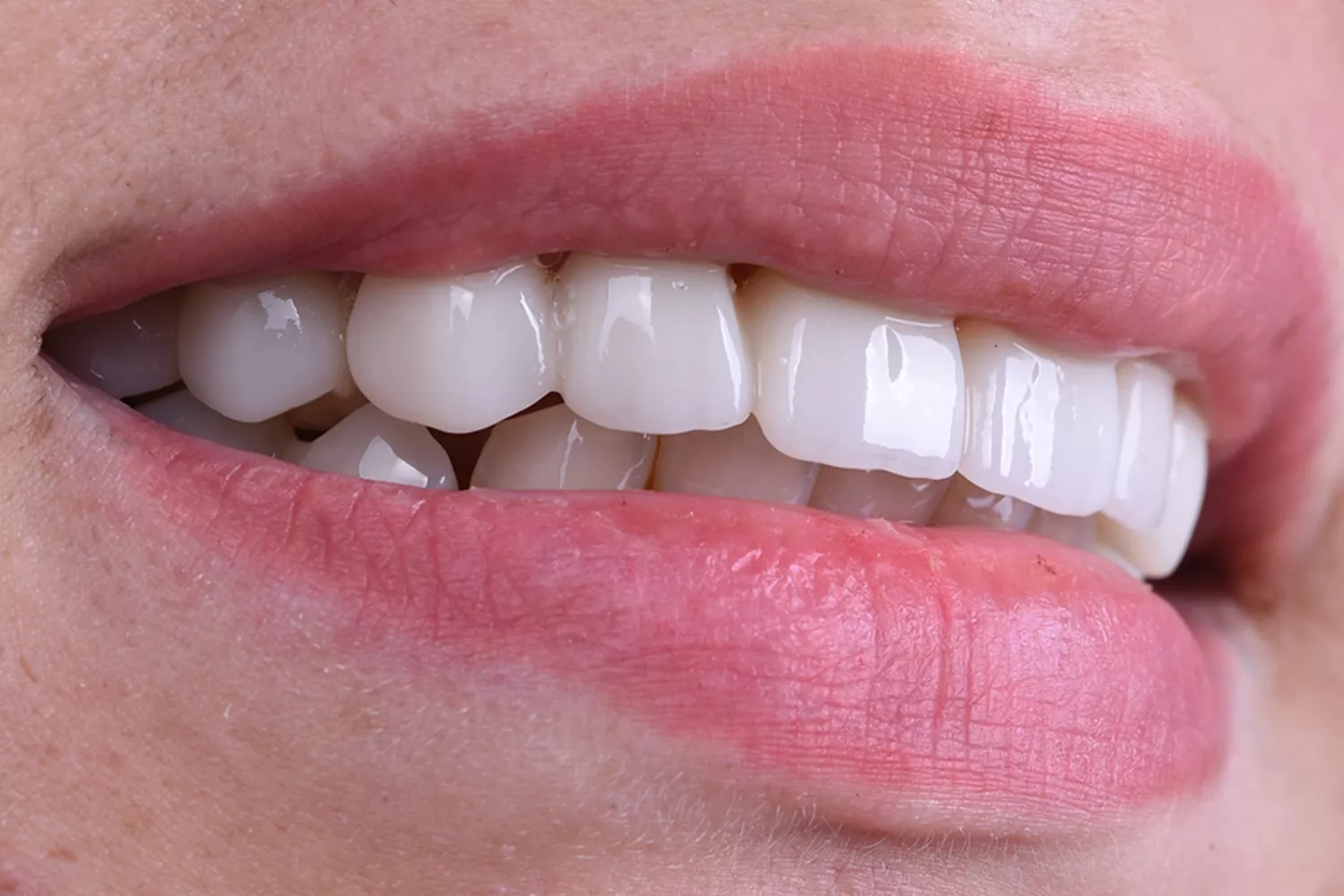  Hollywood Smile in Turkey: Why Expats in Bursa Choose MilimDental for Natural Aesthetic Smile Design