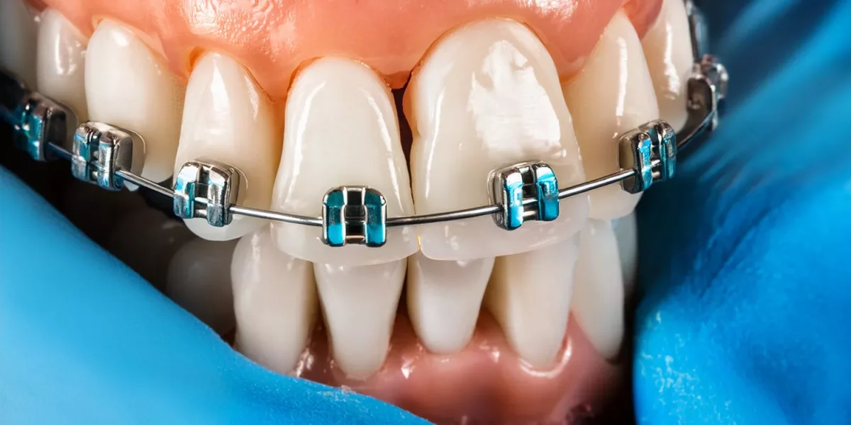 Missing Teeth and Orthodontic Braces Treatment