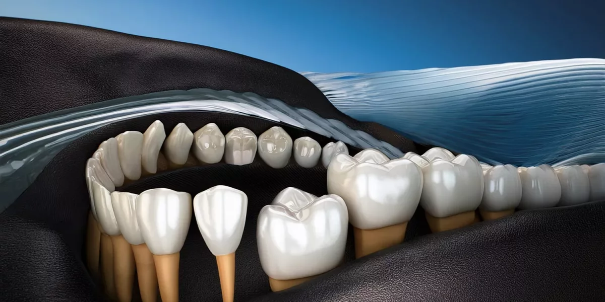 大补牙与锆石修复