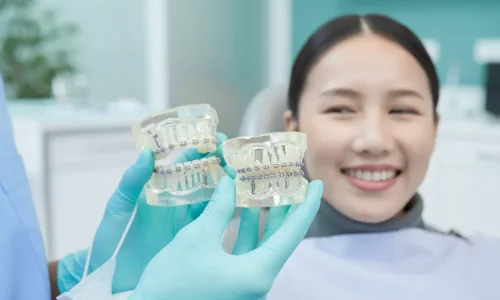 Керамические брекеты так же эффективны, как металлические? - Milim Dental Hospital