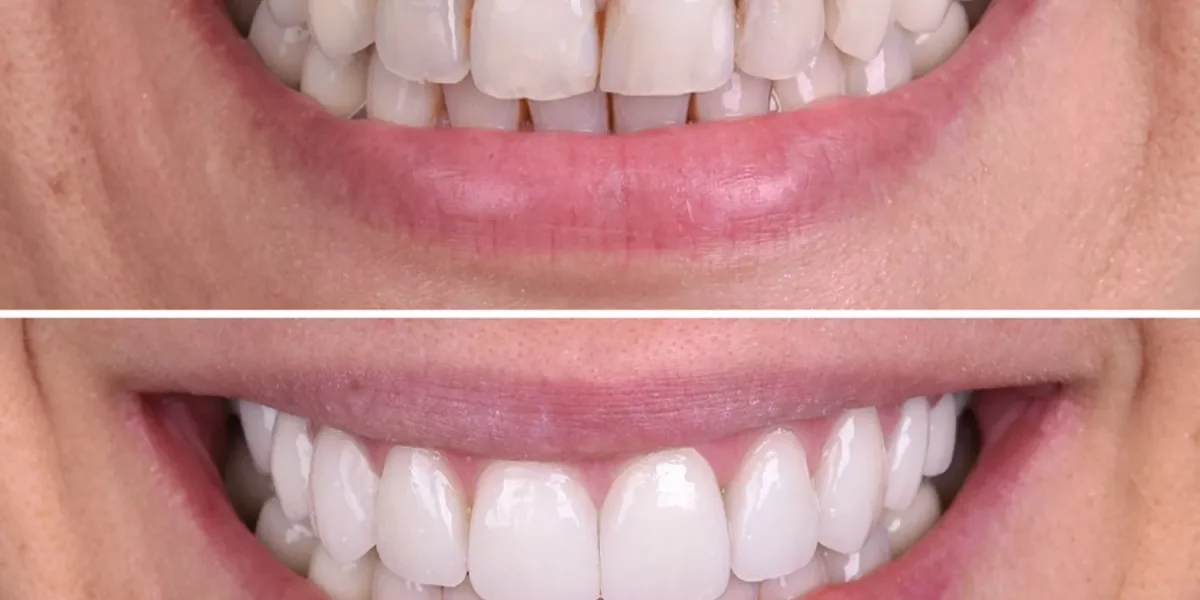 Why Do So Many People Want a Hollywood Smile Now?