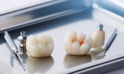재료 설명: 지르코니아 vs Emax, 나사 고정식 vs 시멘트 고정식 - Milim Dental Hospital