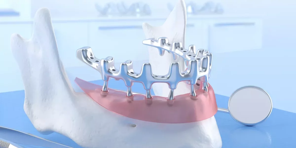 What Are Subperiosteal Implants?