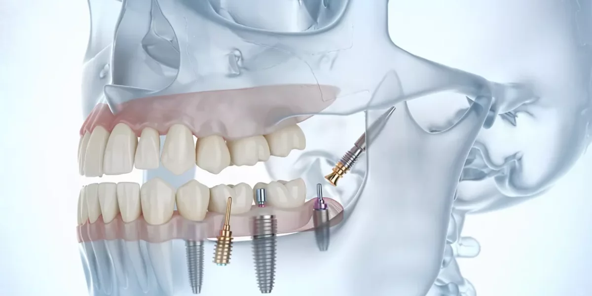 Zygomatic Implants for Severe Upper Jaw Bone Loss