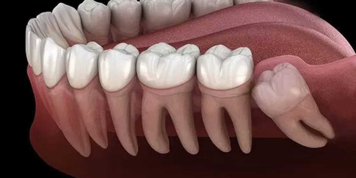 “Πρέπει Σίγουρα να Αφαιρεθούν οι Φρονιμίτες;” — Η Ειλικρινής Απάντηση