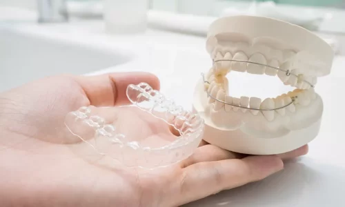 Retainers na orthodontie: vaste vs doorzichtige retainers en hoe lang? - Milim Dental Hospital