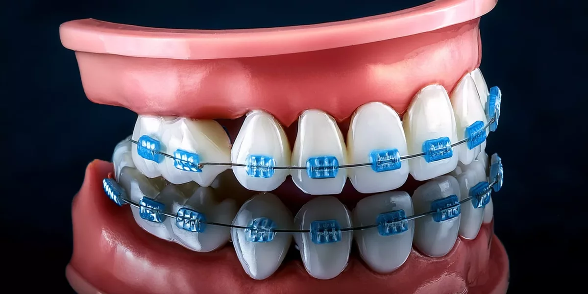 牙齒矯正，健康下顎：為何正畸學不僅僅是為了外觀