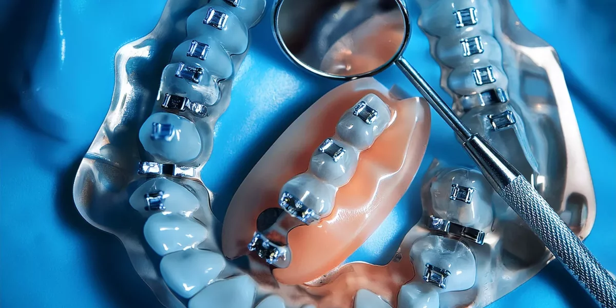 Mild Dental Crowding: Do I Really Need Extractions or Just Invisalign?