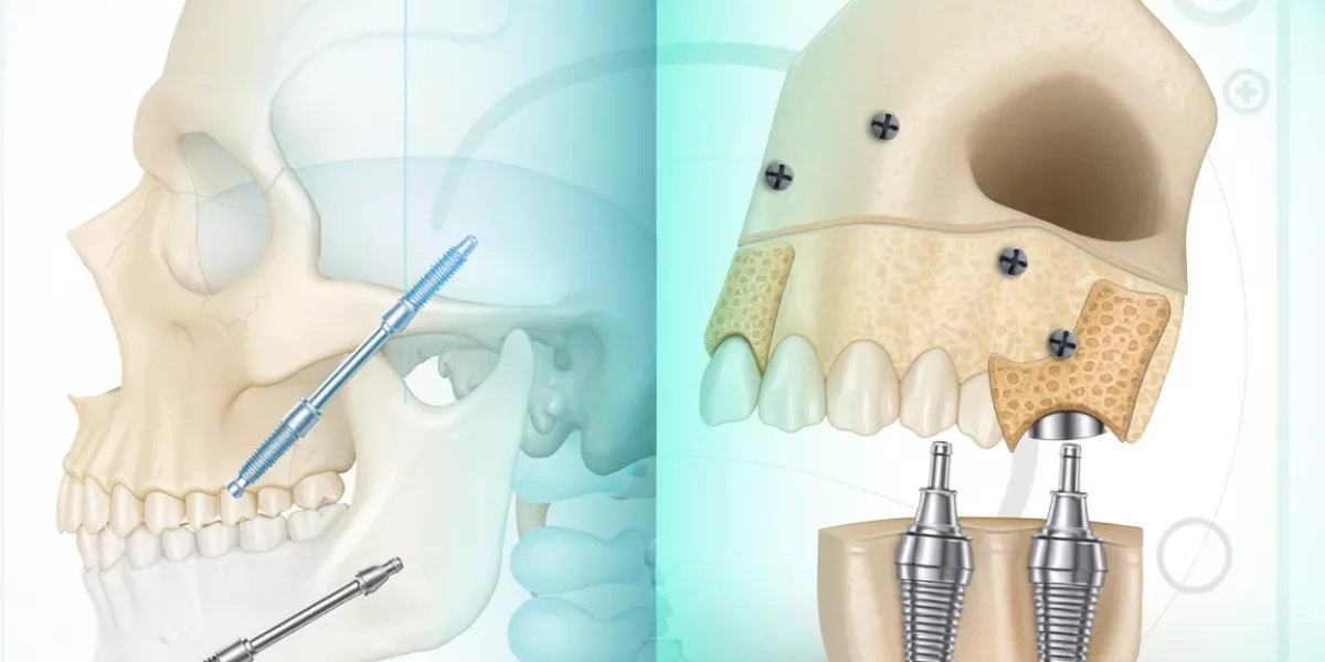 Zygomatic Implants vs Bone Grafting: Which Is More Predictable?