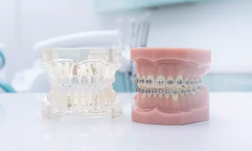 هل يمكن لـ Invisalign تصحيح العضة المعكوسة أو العضة العميقة؟ - Milim Dental Hospital