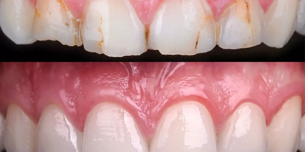 Is a Hollywood Smile Always Veneers?