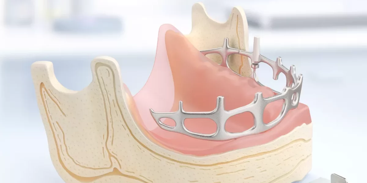 Subperiosteal Implants and Severe Bone Loss