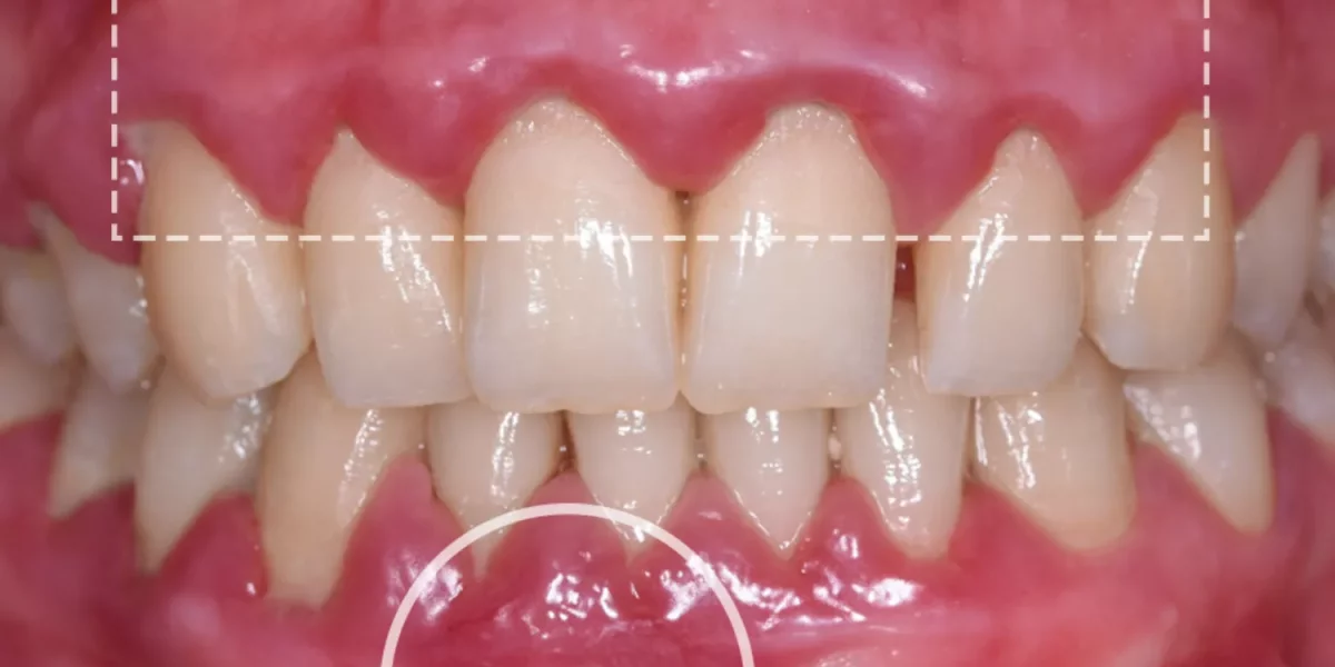 牙齦疾病、牙齦出血及如何保護您的牙齒