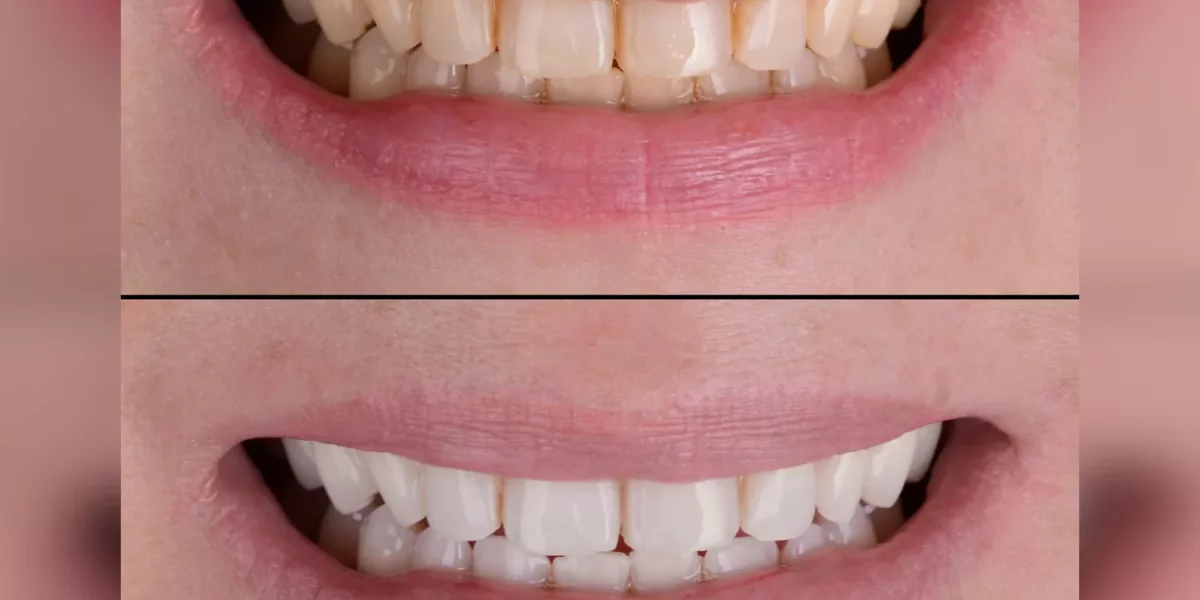 日常口腔健康完整指南—從填充到美白