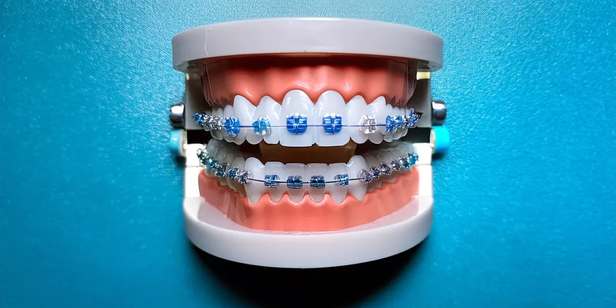 Do I Really Need Braces or Can Invisalign Fix My Dental Crowding?