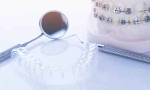 Is Invisalign Suitable for Every Case? - Milim Dental Hospital