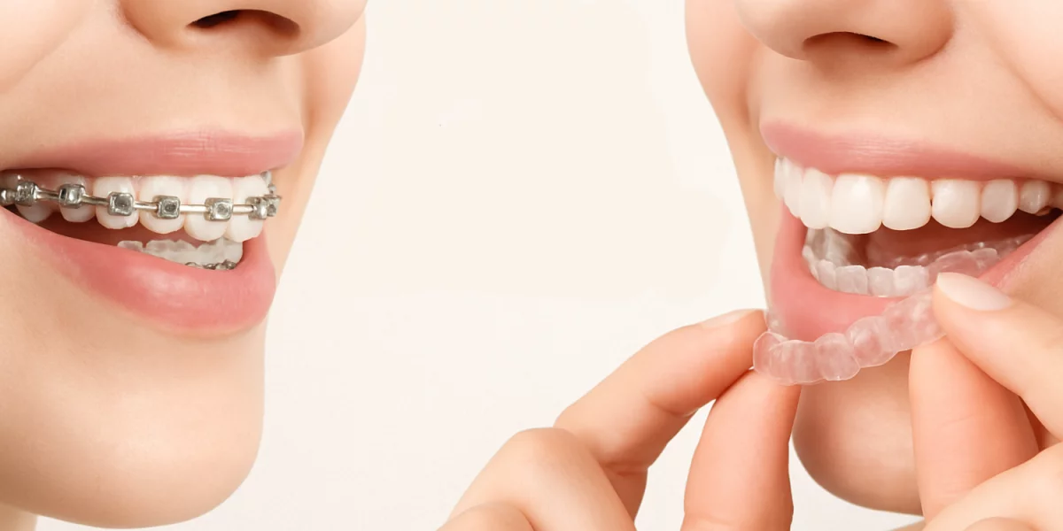 Брекеты или Invisalign?