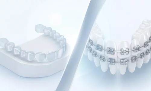 どちらが速いですか：アライナーかブレースか？ - Milim Dental Hospital