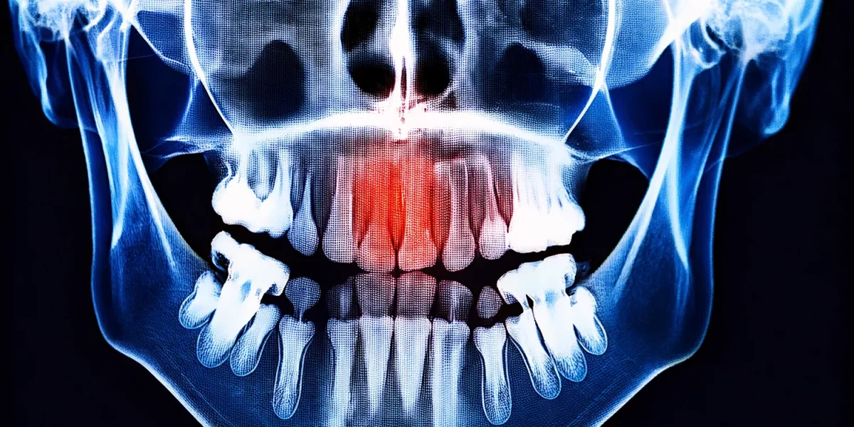 顎の嚢胞か腫瘍か？パノラマX線の「影」は何を意味するのか？