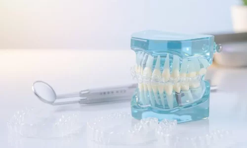 Are aligners suitable for moderate crowding? - Milim Dental Hospital