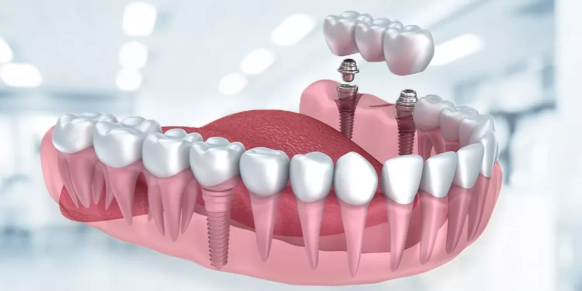 Dental Implants in Turkey: Timeline, Healing & What Happens After You Fly Home?