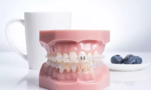 I brackets in ceramica si macchiano? - Milim Dental Hospital