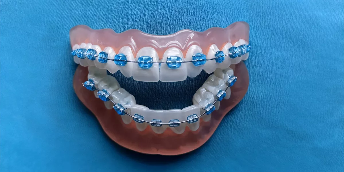 Waarom wordt Invisalign verkozen boven Linguale Brackets?
