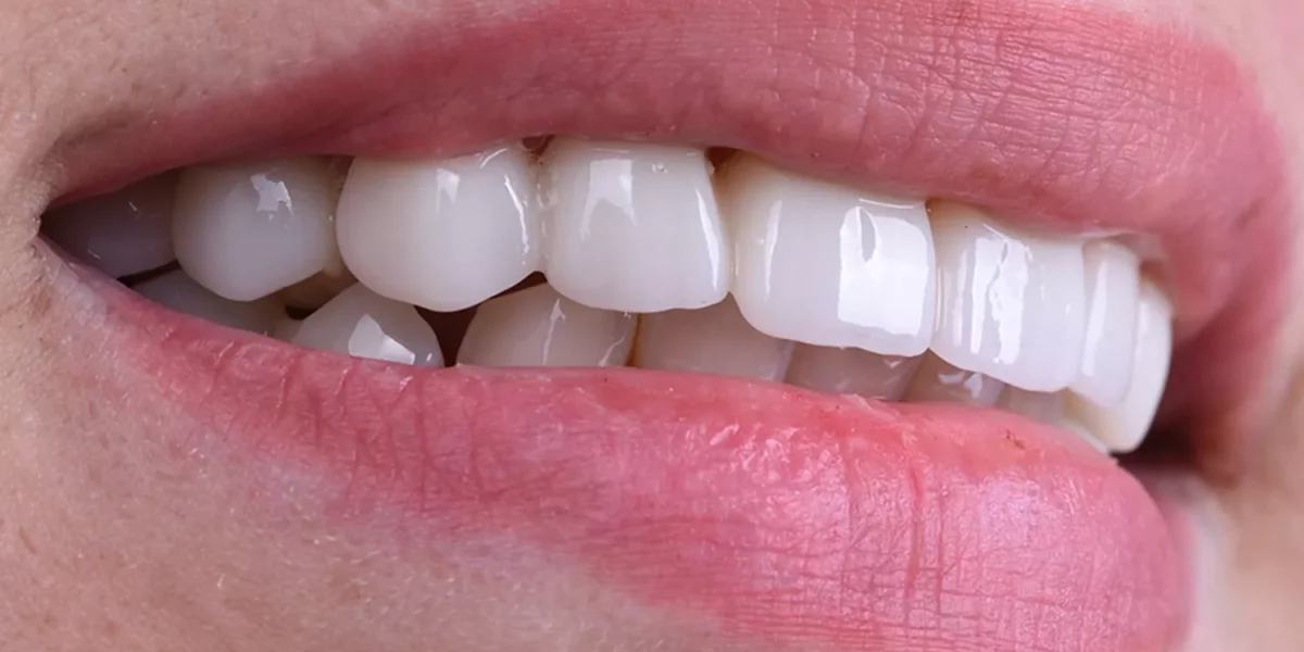 Hollywood-Smile-stin-Toyrkia-Why-Expats-stin-Bursa-Choose-MilimDental-gia-Natural-Aesthetic-Smile-Design