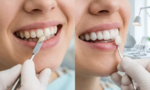 Composite Bonding vs Veneers: Which Cosmetic Option Fits You Better? - Milim Dental Hospital