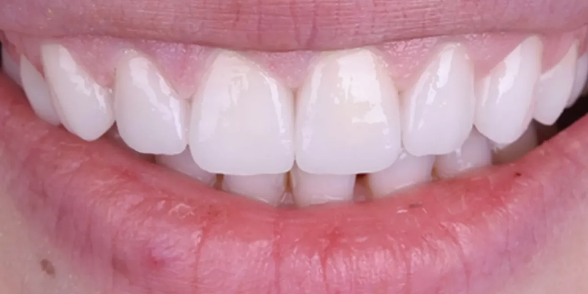 Natural-Looking Hollywood Smile: What American Patients Should Know