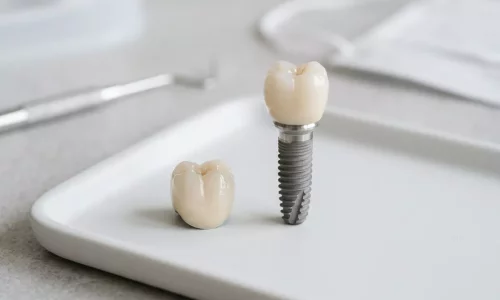 Dental Implant vs Crown: What Is the Difference and Which One Do You Need? - Milim Dental Hospital