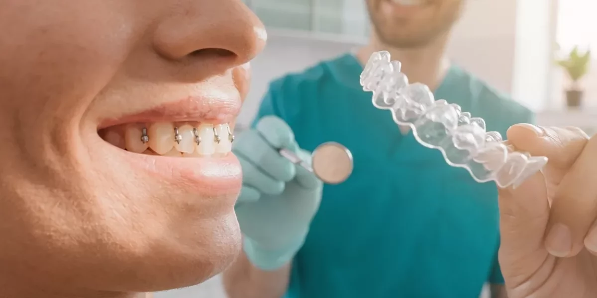 Fikse (Butonat) në Invisalign: Çfarë Bëjnë dhe Pse Ju Nevojiten