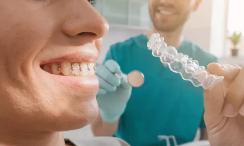 Attachment (Buttons) in Invisalign: What They Do and Why You Need Them - Milim Dental Hospital