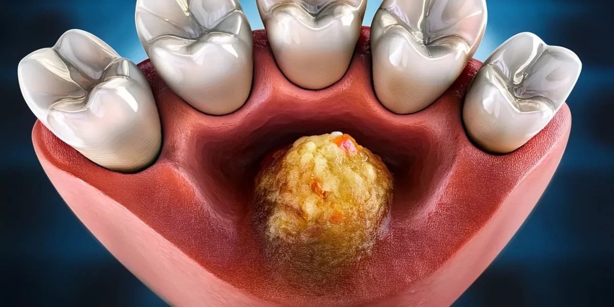 ? Abcès persistant après un traitement de canal: Qu'est-ce que la chirurgie de l'extrémité radiculaire (résection apicale)?