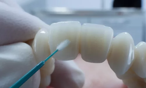 베니어 접착 프로토콜 수명: 베니어가 오래가는 이유 - Milim Dental Hospital