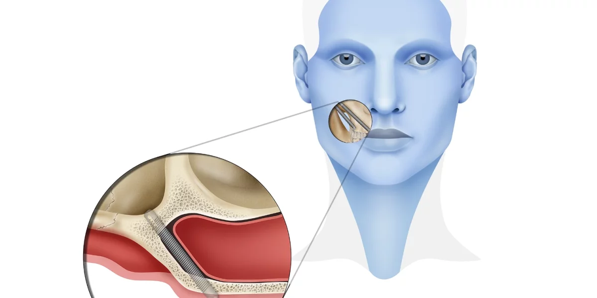 顎の骨が失われた場合の頬骨インプラントの利点
