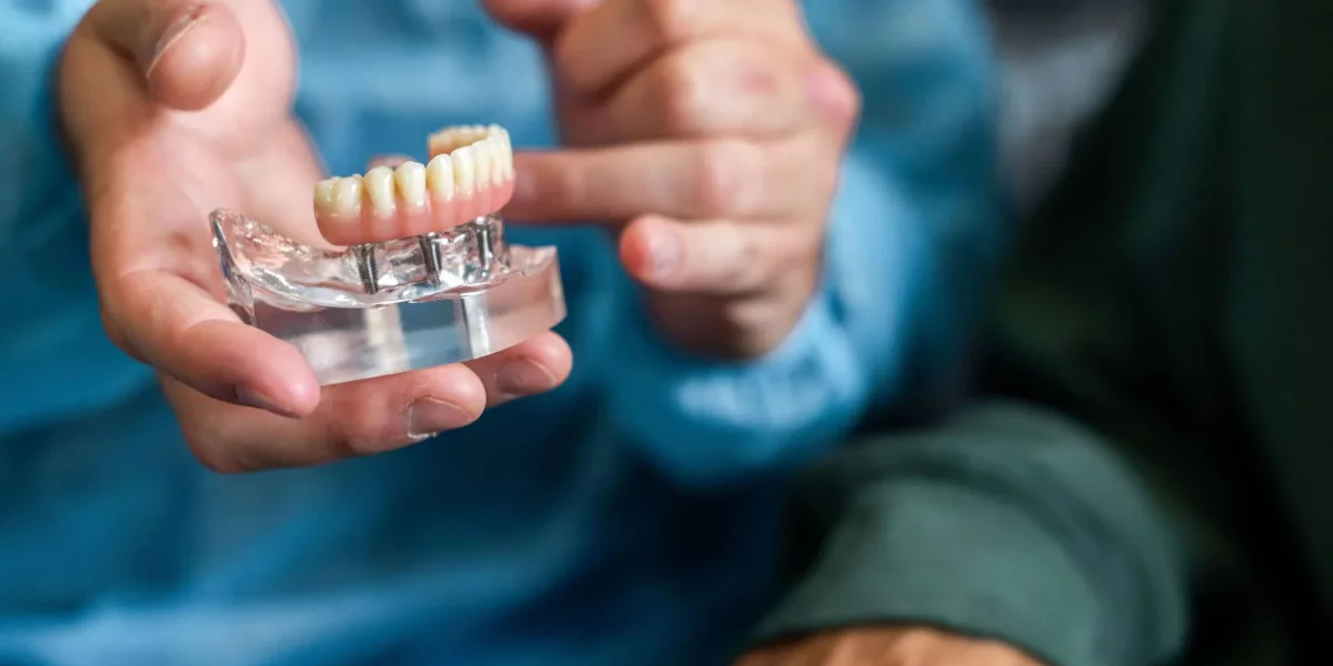 All-on-4 Dental Implants: A Life-Changing Solution