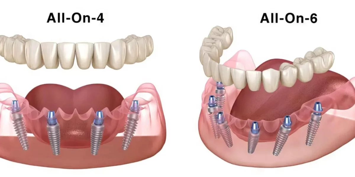 All-on-4 vs. All-on-X: What’s the Difference?