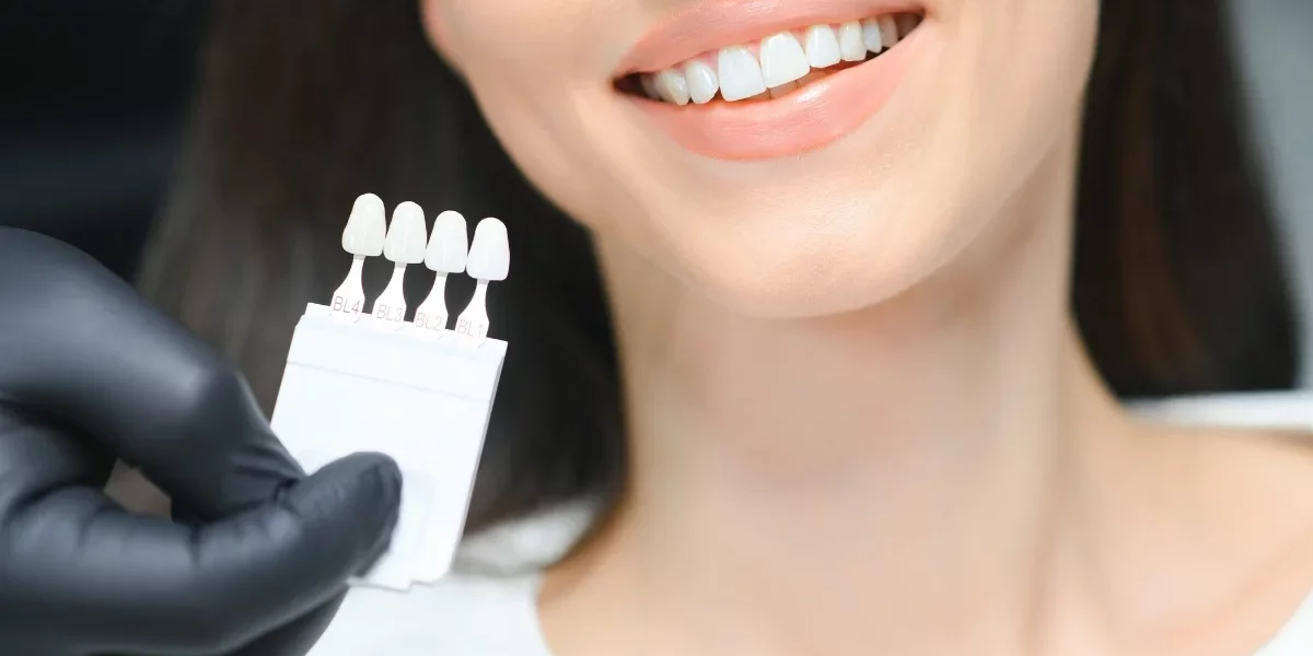 Are Veneers Right for You? How to Determine If You’re a Candidate