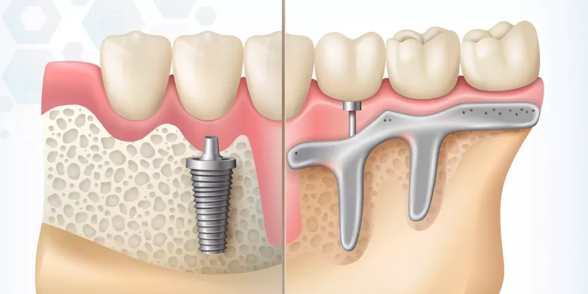 Subperiosteal Implants vs Traditional Dental Implants