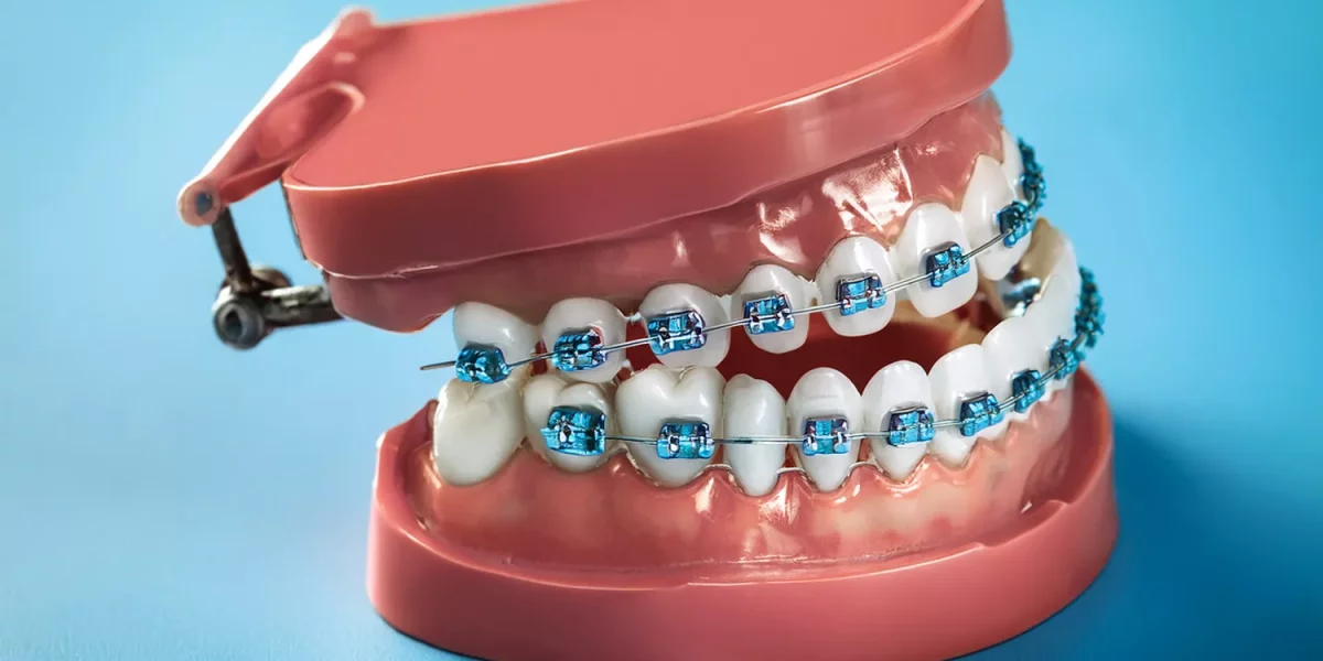 Ортодонтски третмани и стоматолошки импланти: Зошто редоследот и времето се важни