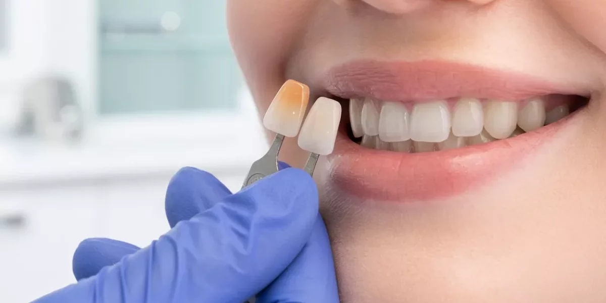 Shade Selection for Dutch Patients: How to Avoid “Too White” Teeth
