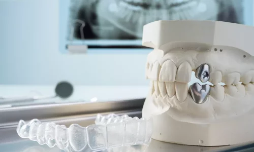 Which cases are not suitable for Invisalign? - Milim Dental Hospital