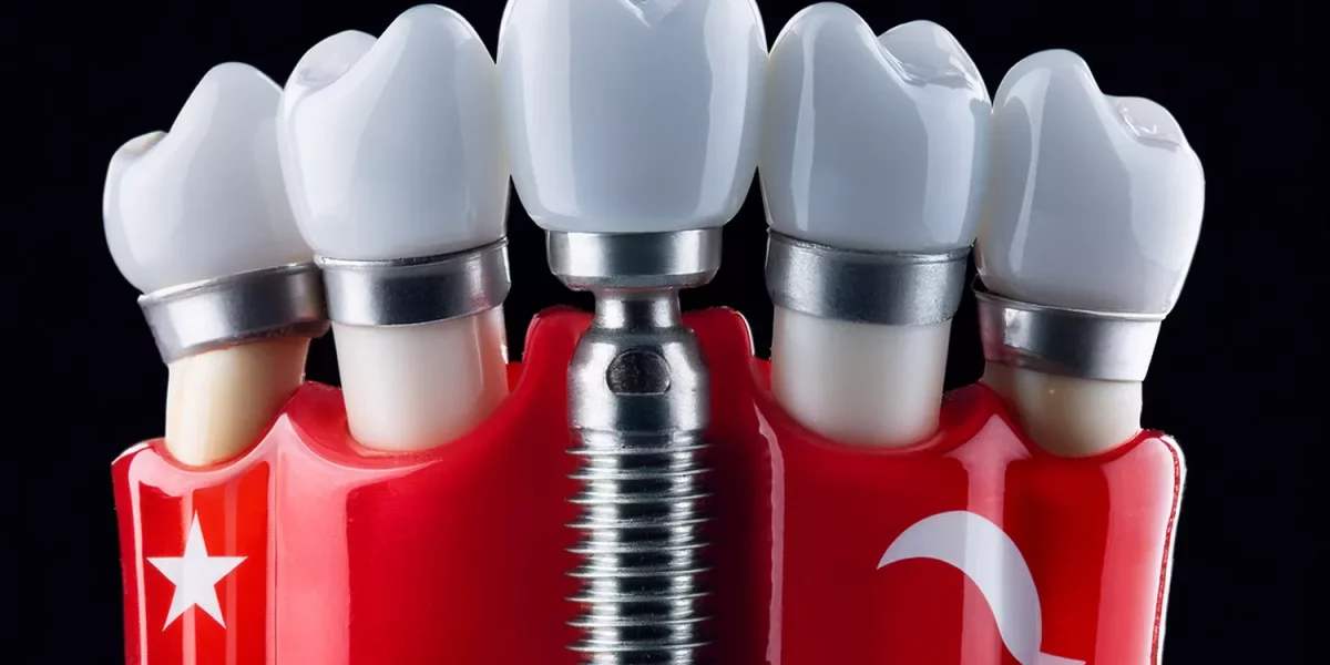 土耳其的牙齒植體：整個過程到底需要多久？