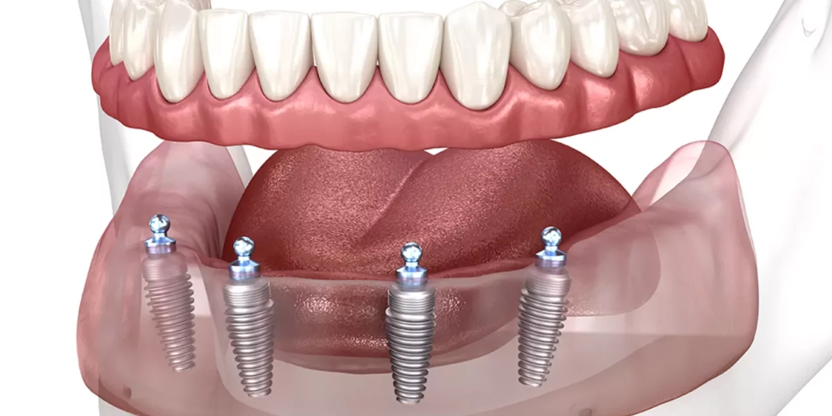 All-on-4 with Angled Implants: When Is It Enough, and When Do You Need More Implants?