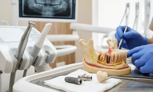 What Really Affects the Cost of a Dental Implant? - Milim Dental Hospital