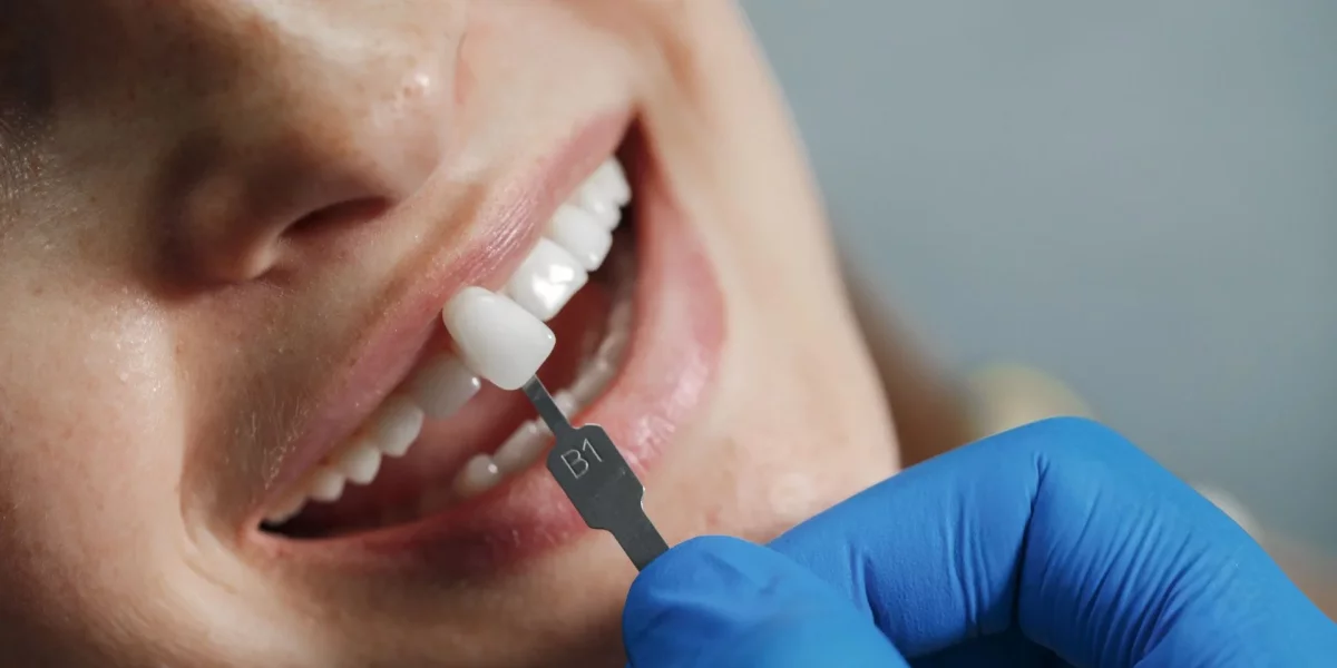 Dental Veneers in Turkey: Enhance Your Smile Instantly