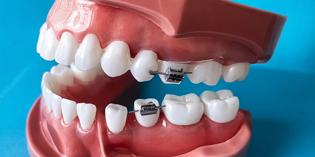 Will My Teeth Go Back to Their Old Position After Orthodontics?